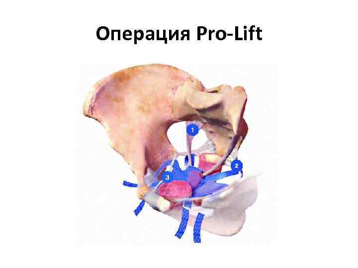 Операция Pro-Lift 