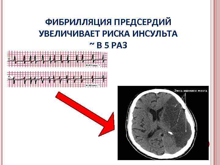 ФИБРИЛЛЯЦИЯ ПРЕДСЕРДИЙ УВЕЛИЧИВАЕТ РИСКА ИНСУЛЬТА ~ В 5 РАЗ 