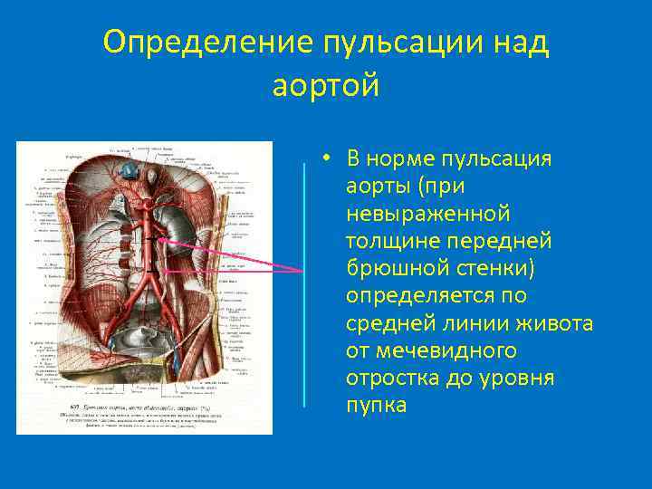 Определение пульсации над аортой • В норме пульсация аорты (при невыраженной толщине передней брюшной