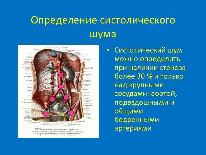 Определение систолического шума • Систолический шум можно определить при наличии стеноза более 30 %