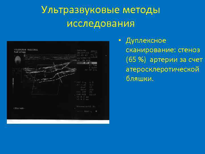 Ультразвуковые методы исследования • Дуплексное сканирование: стеноз (65 %) артерии за счет атеросклеротической бляшки.