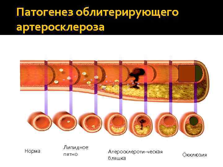 Патогенез облитерирующего артеросклероза Норма Липидное пятно Атеросклероти-ческая бляшка Окклюзия 