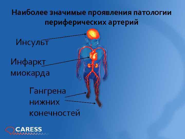 Наиболее значимые проявления патологии периферических артерий Инсульт Инфаркт миокарда Гангрена нижних конечностей 