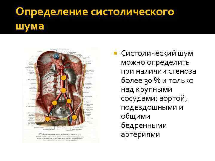 Определение систолического шума Систолический шум можно определить при наличии стеноза более 30 % и