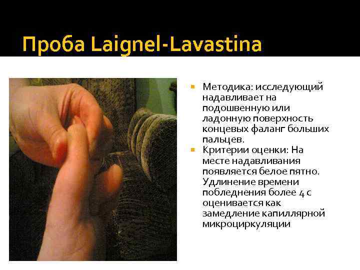 Проба Laignel-Lavastina Методика: исследующий надавливает на подошвенную или ладонную поверхность концевых фаланг больших пальцев.