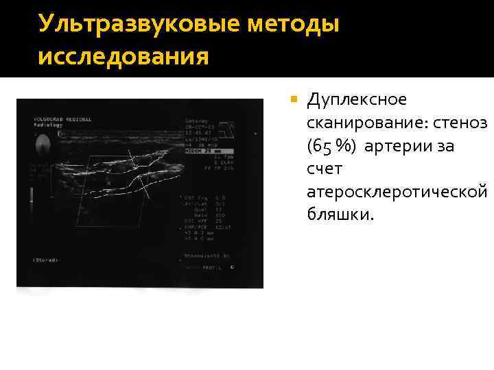 Ультразвуковые методы исследования Дуплексное сканирование: стеноз (65 %) артерии за счет атеросклеротической бляшки. 