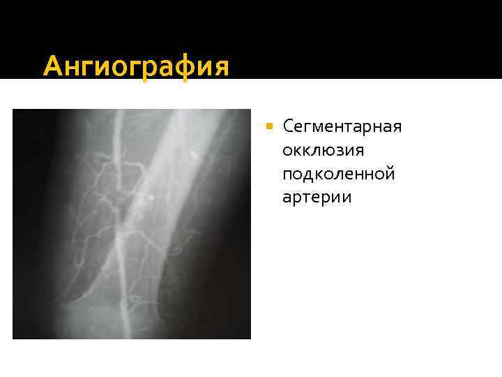 Ангиография Сегментарная окклюзия подколенной артерии 