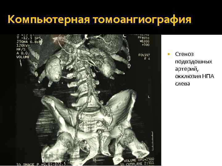 Компьютерная томоангиография Стеноз подвздошных артерий, окклюзия НПА слева 