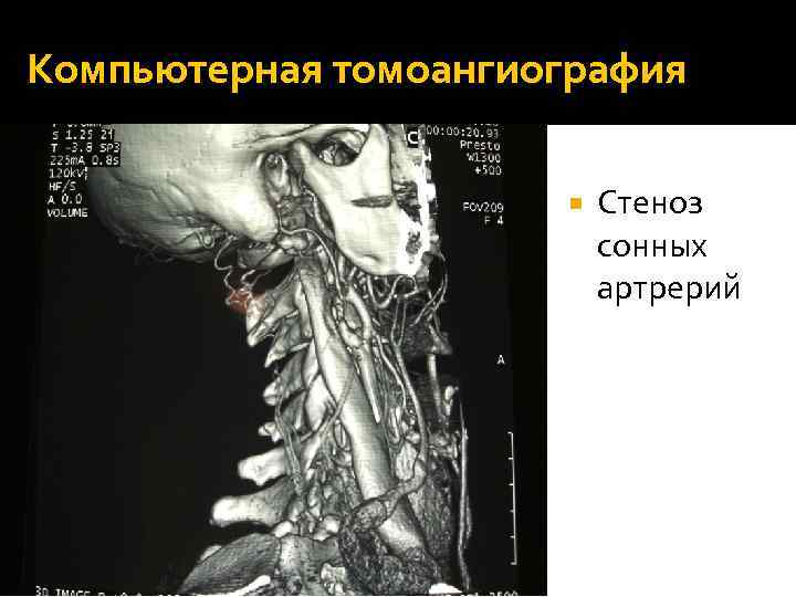 Компьютерная томоангиография Стеноз сонных артрерий 