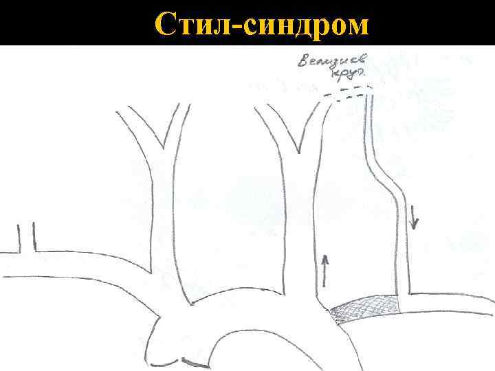 Стил-синдром 