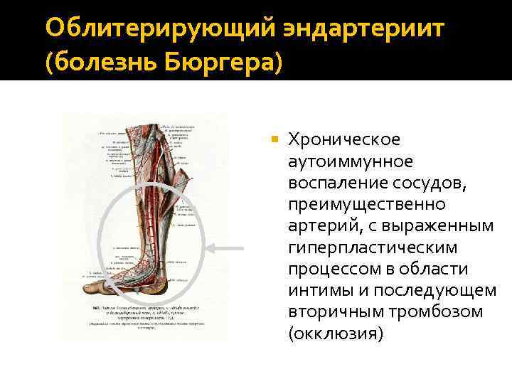 Облитерирующий эндартериит (болезнь Бюргера) Хроническое аутоиммунное воспаление сосудов, преимущественно артерий, с выраженным гиперпластическим процессом