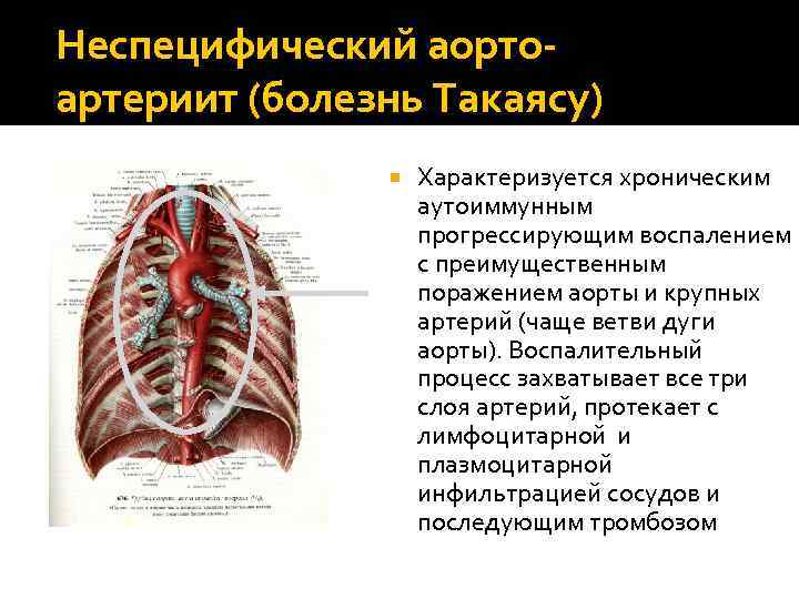 Неспецифический аортоартериит (болезнь Такаясу) Характеризуется хроническим аутоиммунным прогрессирующим воспалением с преимущественным поражением аорты и