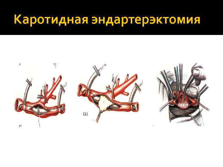 Каротидная эндартерэктомия 