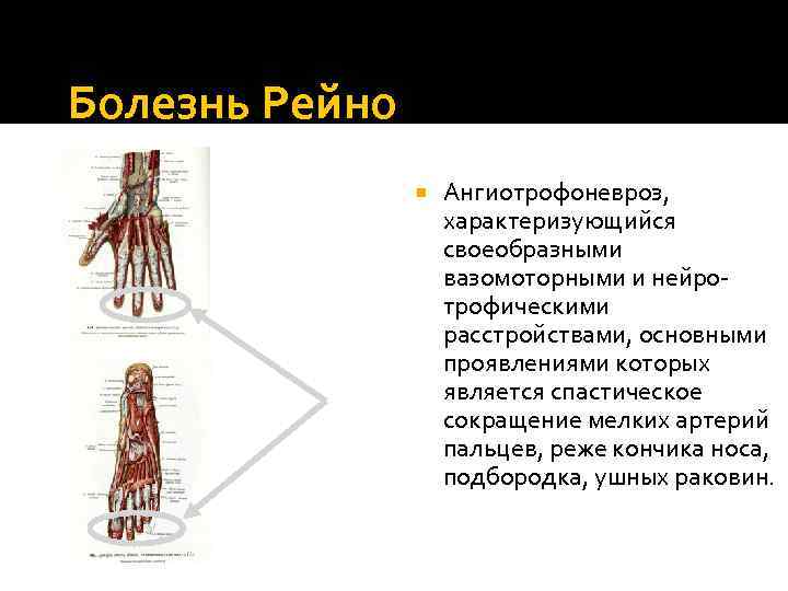 Болезнь Рейно Ангиотрофоневроз, характеризующийся своеобразными вазомоторными и нейротрофическими расстройствами, основными проявлениями которых является спастическое