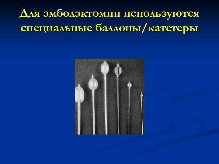 Для эмболэктомии используются специальные баллоны/катетеры 