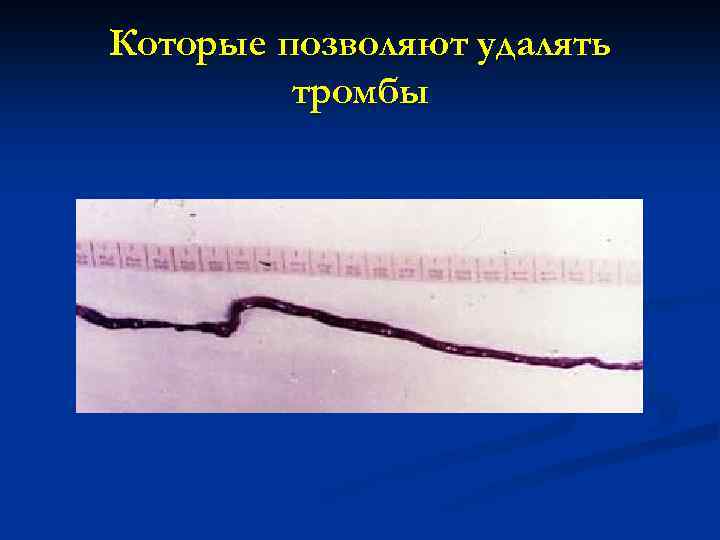 Которые позволяют удалять тромбы 