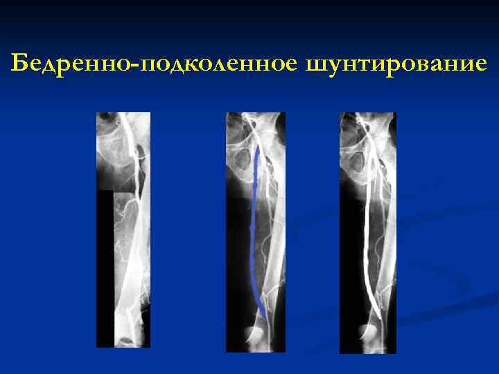 Бедренно-подколенное шунтирование 