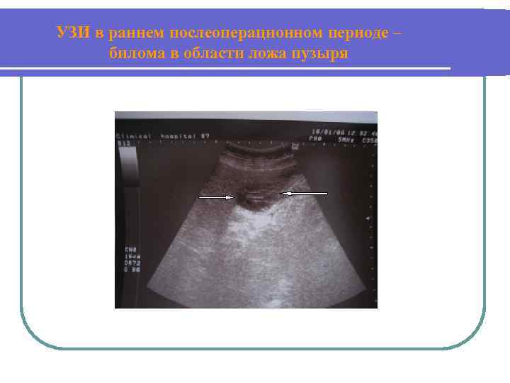 УЗИ в раннем послеоперационном периоде – билома в области ложа пузыря 