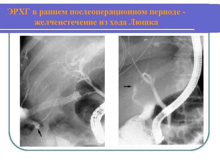 ЭРХГ в раннем послеоперационном периоде желчеистечение из хода Люшка 