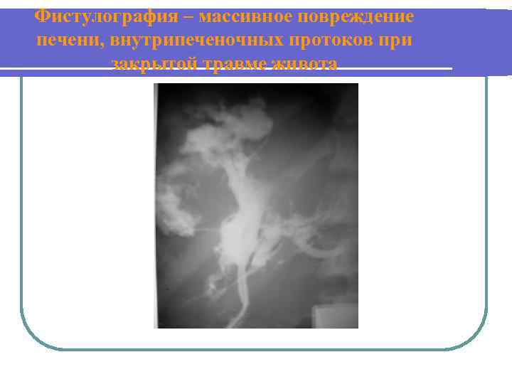 Фистулография – массивное повреждение печени, внутрипеченочных протоков при закрытой травме живота 
