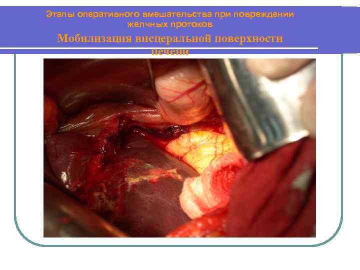 Этапы оперативного вмешательства при повреждении желчных протоков Мобилизация висцеральной поверхности печени 