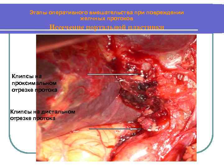 Этапы оперативного вмешательства при повреждении желчных протоков Иссечение портальной пластинки Клипсы на проксимальном отрезке