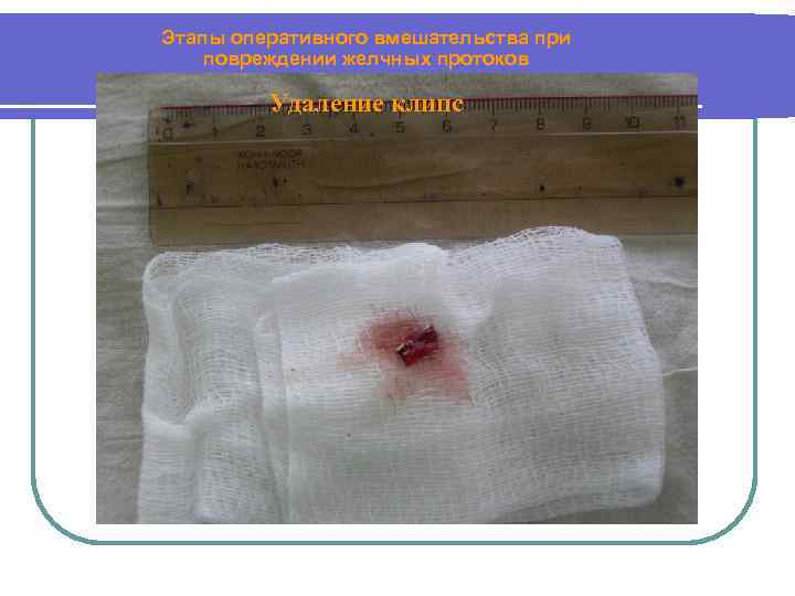 Этапы оперативного вмешательства при повреждении желчных протоков Удаление клипс 