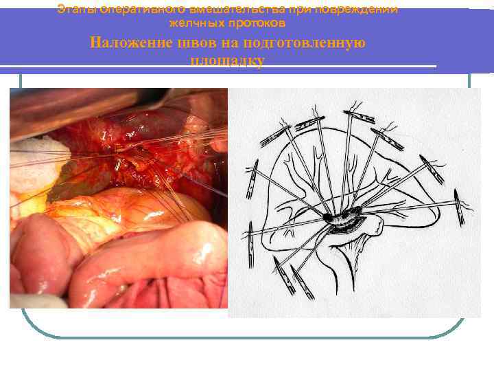 Этапы оперативного вмешательства при повреждении желчных протоков Наложение швов на подготовленную площадку 