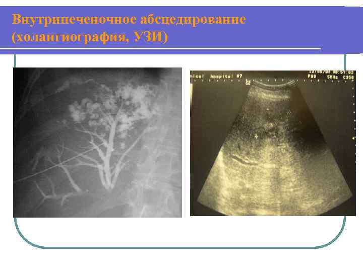 Внутрипеченочное абсцедирование (холангиография, УЗИ) 
