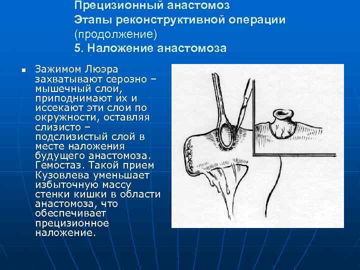 Прецизионный анастомоз Этапы реконструктивной операции (продолжение) 5. Наложение анастомоза n Зажимом Люэра захватывают серозно