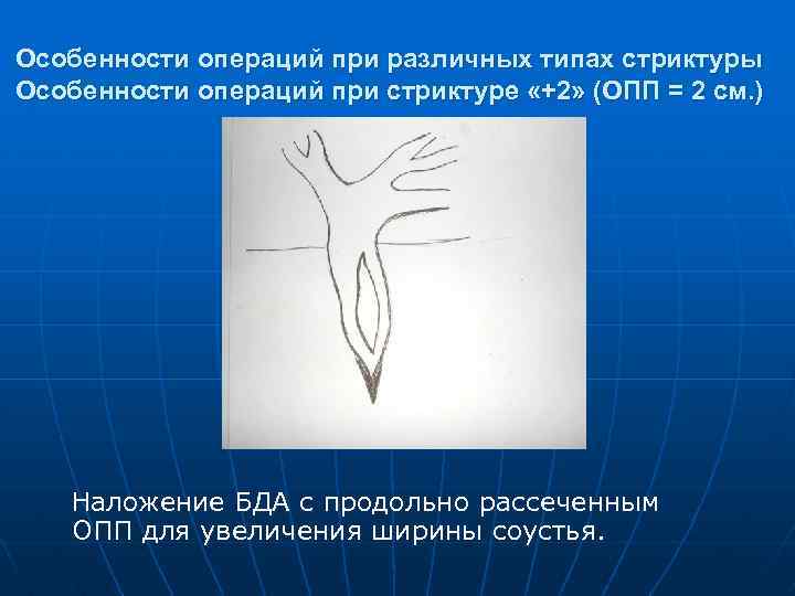 Особенности операций при различных типах стриктуры Особенности операций при стриктуре «+2» (ОПП = 2