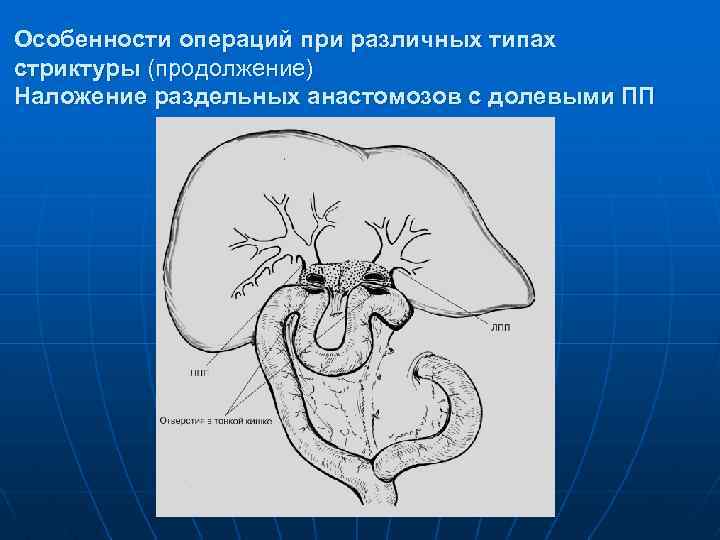 Особенности операций при различных типах стриктуры (продолжение) Наложение раздельных анастомозов с долевыми ПП 