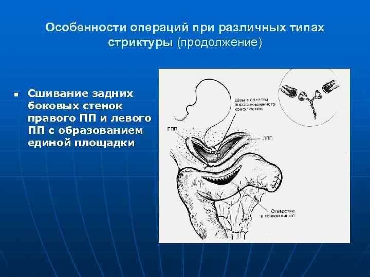 Особенности операций при различных типах стриктуры (продолжение) n Сшивание задних боковых стенок правого ПП