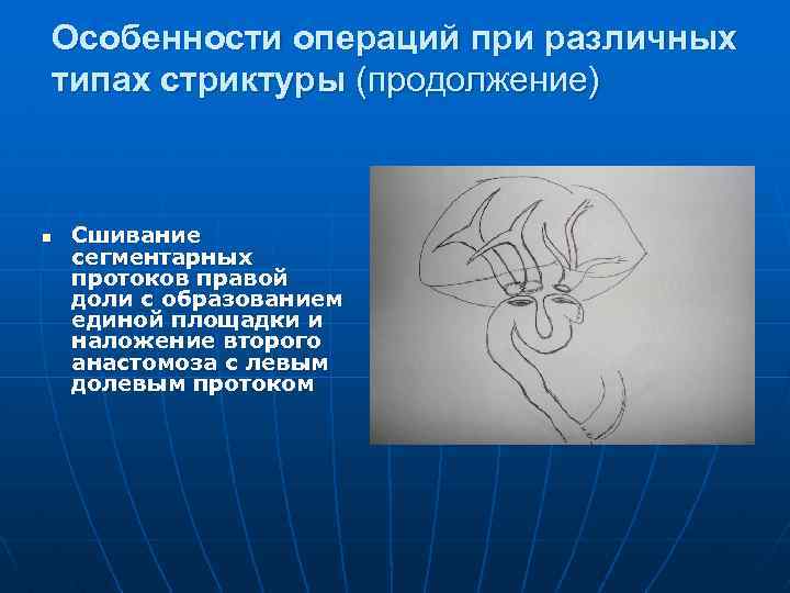 Особенности операций при различных типах стриктуры (продолжение) n Сшивание сегментарных протоков правой доли с
