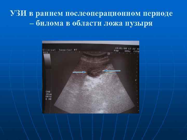 УЗИ в раннем послеоперационном периоде – билома в области ложа пузыря 