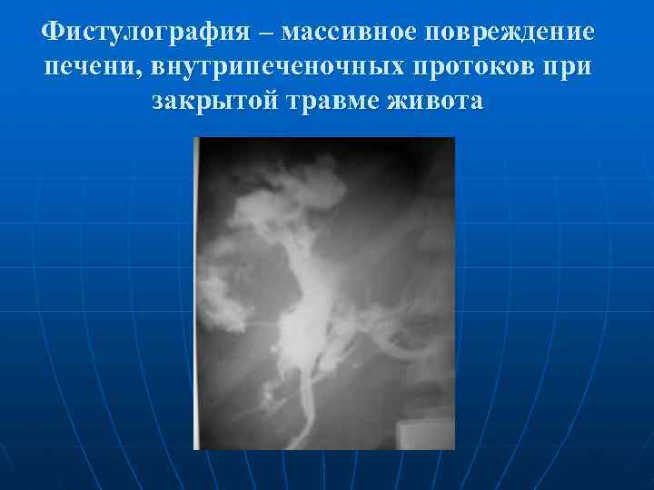 Фистулография – массивное повреждение печени, внутрипеченочных протоков при закрытой травме живота 