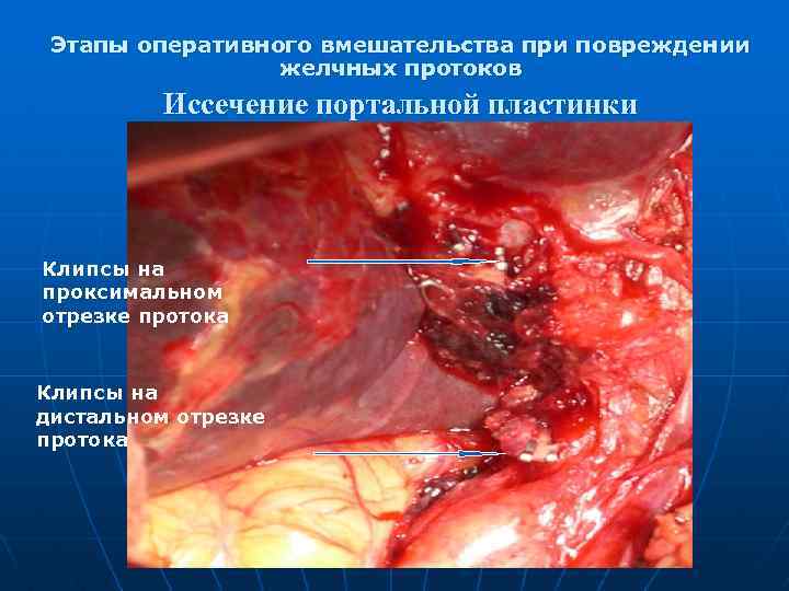 Этапы оперативного вмешательства при повреждении желчных протоков Иссечение портальной пластинки Клипсы на проксимальном отрезке