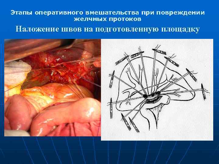 Этапы оперативного вмешательства при повреждении желчных протоков Наложение швов на подготовленную площадку 
