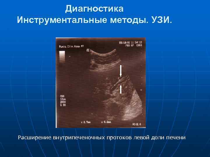 Диагностика Инструментальные методы. УЗИ. Расширение внутрипеченочных протоков левой доли печени 