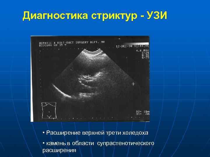 Диагностика стриктур - УЗИ • Расширение верхней трети холедоха • камень в области супрастенотического
