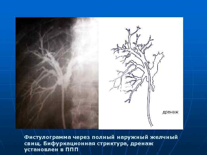 дренаж Фистулограмма через полный наружный желчный свищ. Бифуркационная стриктура, дренаж установлен в ППП 