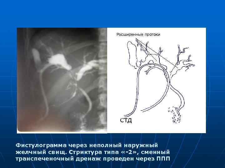 Расширенные протоки СТД Фистулограмма через неполный наружный желчный свищ. Стриктура типа «-2» , сменный
