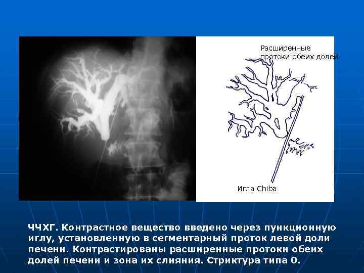 Расширенные протоки обеих долей Игла Chiba ЧЧХГ. Контрастное вещество введено через пункционную иглу, установленную