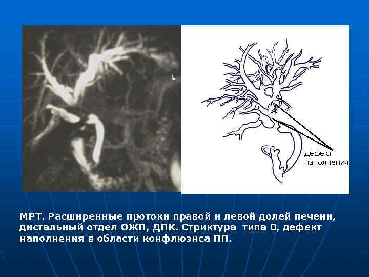 Дефект наполнения МРТ. Расширенные протоки правой и левой долей печени, дистальный отдел ОЖП, ДПК.