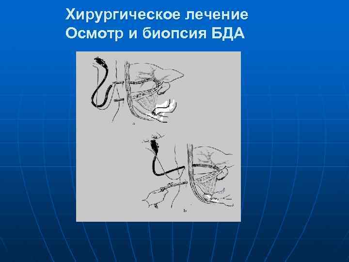 Хирургическое лечение Осмотр и биопсия БДА 