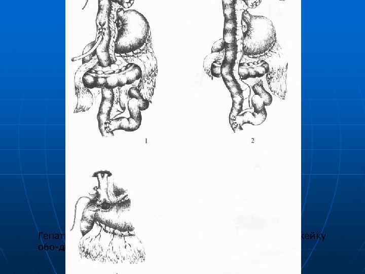 Гепатикоеюностомия с проведением кишки через брыжейку обо дочной кишки и дренированием по Фелькеру; 
