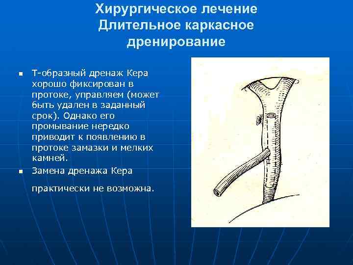 Хирургическое лечение Длительное каркасное дренирование n n Т образный дренаж Кера хорошо фиксирован в
