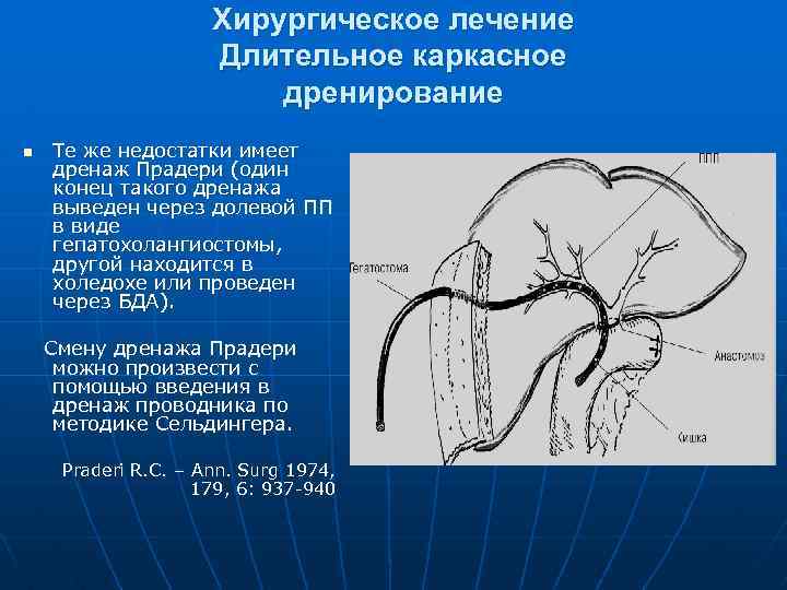Хирургическое лечение Длительное каркасное дренирование n Те же недостатки имеет дренаж Прадери (один конец