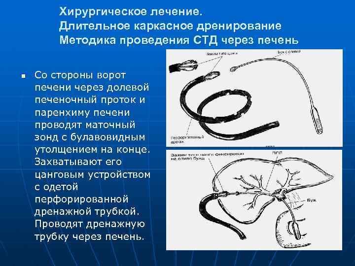 Хирургическое лечение. Длительное каркасное дренирование Методика проведения СТД через печень n Со стороны ворот