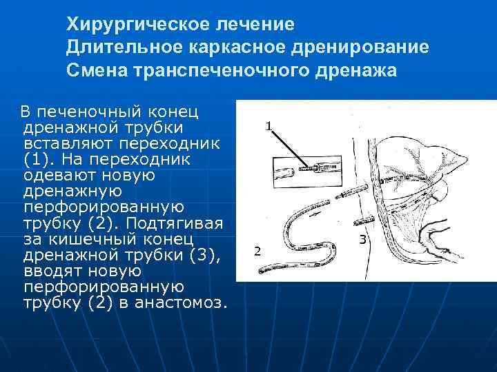 Хирургическое лечение Длительное каркасное дренирование Смена транспеченочного дренажа В печеночный конец дренажной трубки вставляют